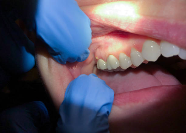 Best Emergency Treatment for Oral Infections in Glen Rock, PA